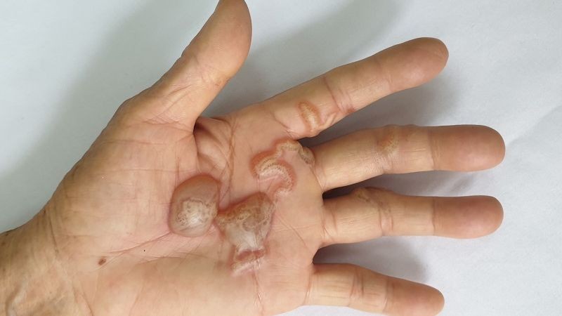 Nhiễm ký sinh trùng từ động vật nuôi trong nhà