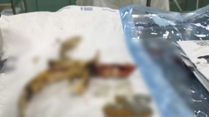Phẫu thuật cứu sống bệnh nhân bị dị vật cắm chặt vào hộp sọ