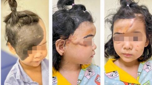 Hành trình tìm lại khuôn mặt xinh đẹp cho bé gái có u hắc tố khổng lồ